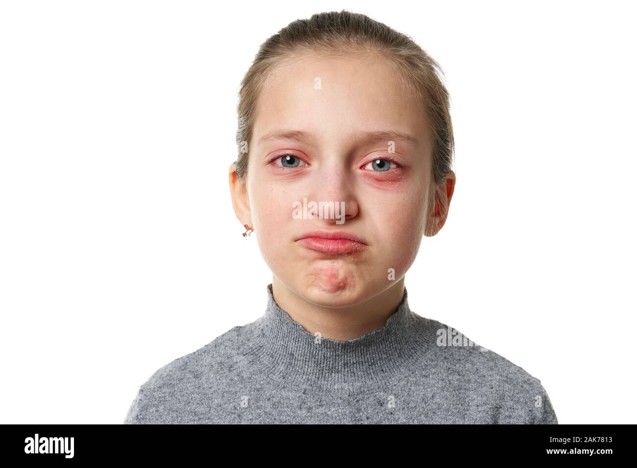 Allergic reaction, skin rash, close view portrait of a girl's face. Redness and inflammation of