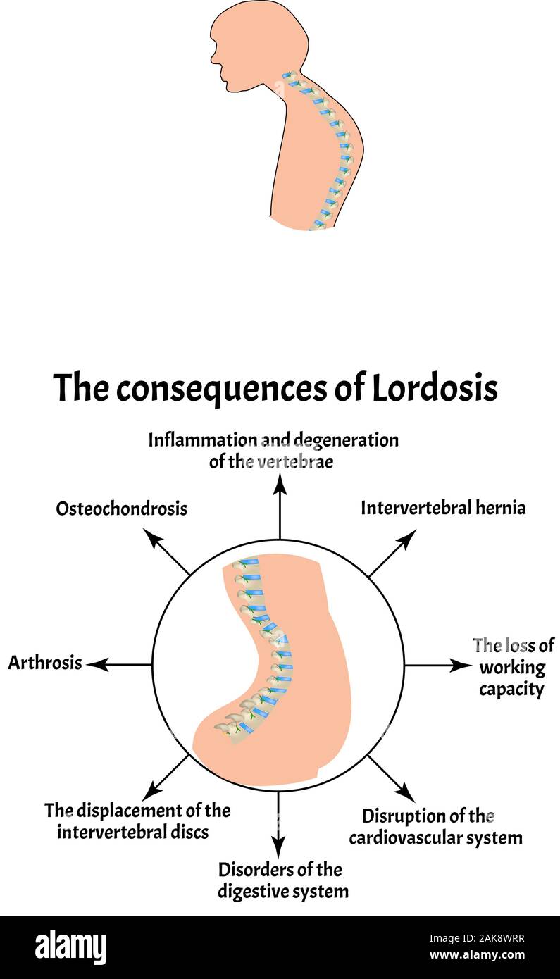 The consequences of lordosis. Spinal curvature, kyphosis, lordosis, scoliosis, arthrosis