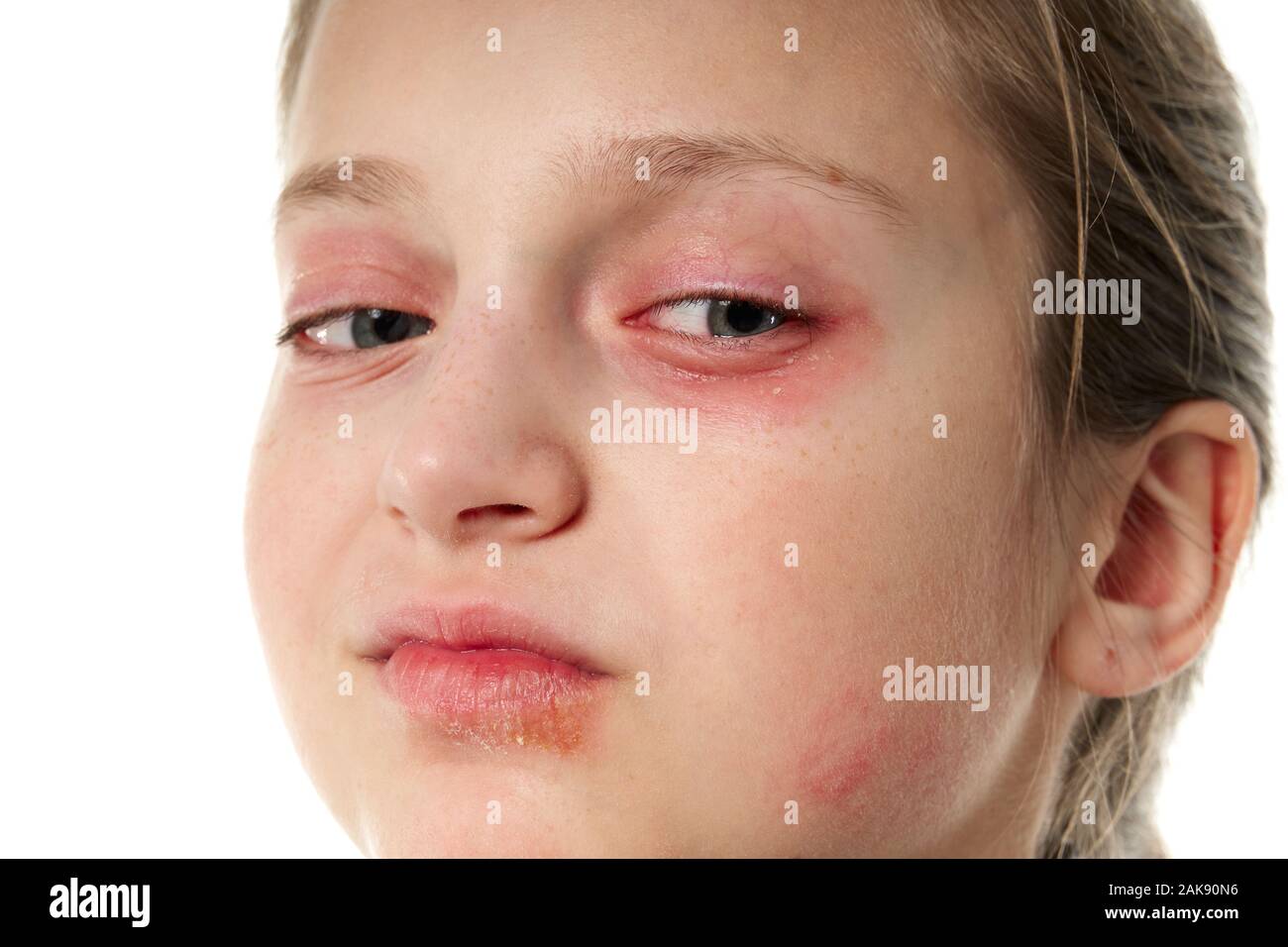 Allergic reaction, skin rash, close view portrait of a girl's face. Redness and inflammation of
