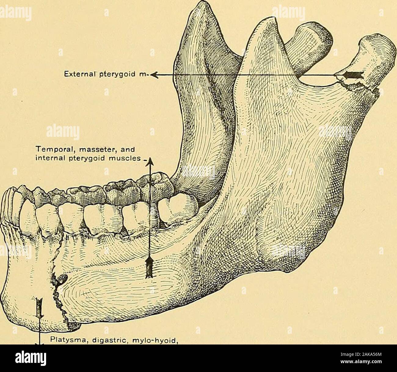 Surgical anatomy : a treatise on human anatomy in its application to the practice of medicine and surgery . xillary fissure. The malar bone can be divided with strongbone forceps, which are not allowed to extend into the spheno-maxillary fissure.If the forceps are inserted too deeply into the fissure, the internal maxillary arterymay be severed. The central incisor on the diseased side is extracted, the niuco-periosteum ofthe floor of the nose is divided close to the nasal septum, the muco-periosteum ofthe hard palate is severed in the median line, and the soft palate is thoroughlyseparated fr Stock Photo