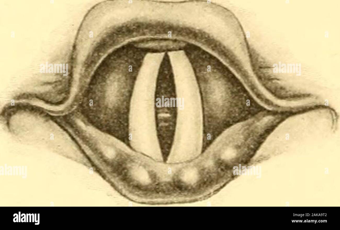 Diseases of the nose and throat . t, to a general muscular atony. A very common form of myopathic paralysis is seen in tin- loss of 400 DISEASES OF THE NOSE AND THROAT. power of the thyroarytenoid muscles resulting from overuse of thelarynx when inflamed. Vocal fatigue from muscular strain, whetherin speaking or singing, often results in this condition. The thyro-arytenoid muscles are the most important and interesting of the in-trinsic muscles of the larynx as regards purity and sweetness of tone.Some of their fibers are distributed to the margin of the cord andare capable of limiting vibrati Stock Photo