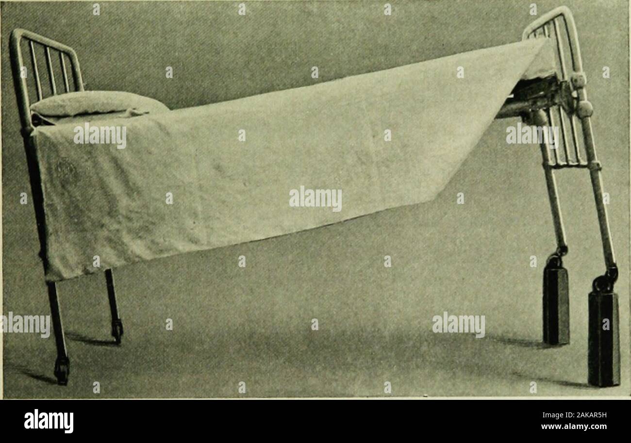 The art of anaesthesia . Fig. 122 —The Fowler position. The head of the bed elevated. hypodermic-ally. Enemas of hot coffee or coffee andbrandy (2 Oz.) are efficient. Hysteria.—Where, by virtue of improper preliminarytreatment, the induction has been stormy, it is not unusualto find an equally stormy recovery. Neurotic, hystericalwomen, particularly if addicted to alcohol or drugs, maygive a great deal of trouble. Every case must be individ-ualized. Such patients often bear large doses of morphine POST-OPERATIVE TREATMENT OF PATIENT 293 well and can be quieted only by this means. Of greaterimp Stock Photo