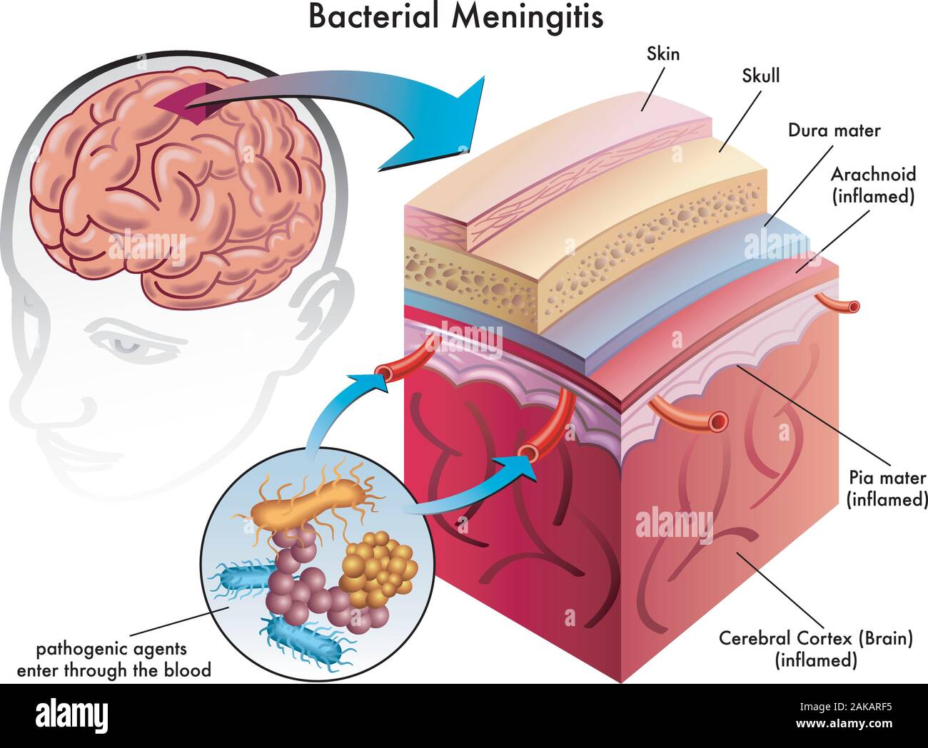 Medical illustration of symptoms of bacterial meningitis. Stock Vector