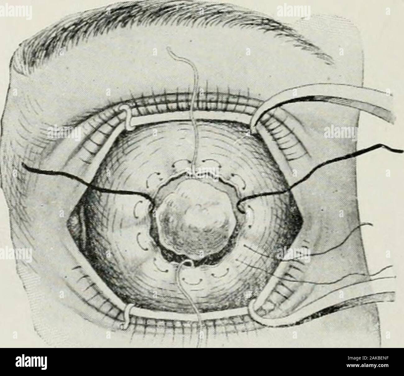 the american encyclopedia and dictionary of ophthalmology edited by casey awood assisted by a large staff of collaborators abscission method of lagrange diagram showing the muscles all sutured andthe purse string suture applied abscission method of lagrange showing the purse string sutures holding themuscles protruding from the opening abscission of the eye 39 the cut edges sutured and the remaining globar tissues form a padfor an artificial eye the operation was first proposed by saint ivesin the 18th century but since that time many operators have favoredvarious forms of abscissi 2AKBENF