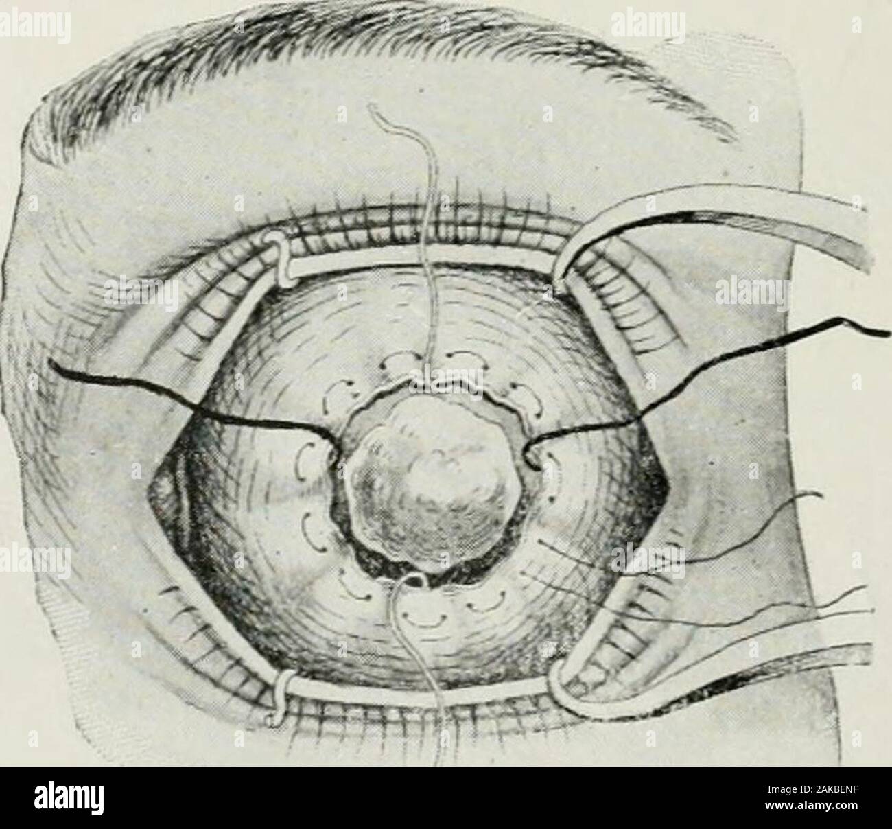 Groin Haemostasis With a Purse String Suture for Patients Following  Catheter Ablation Procedures (GITAR Study) - ScienceDirect