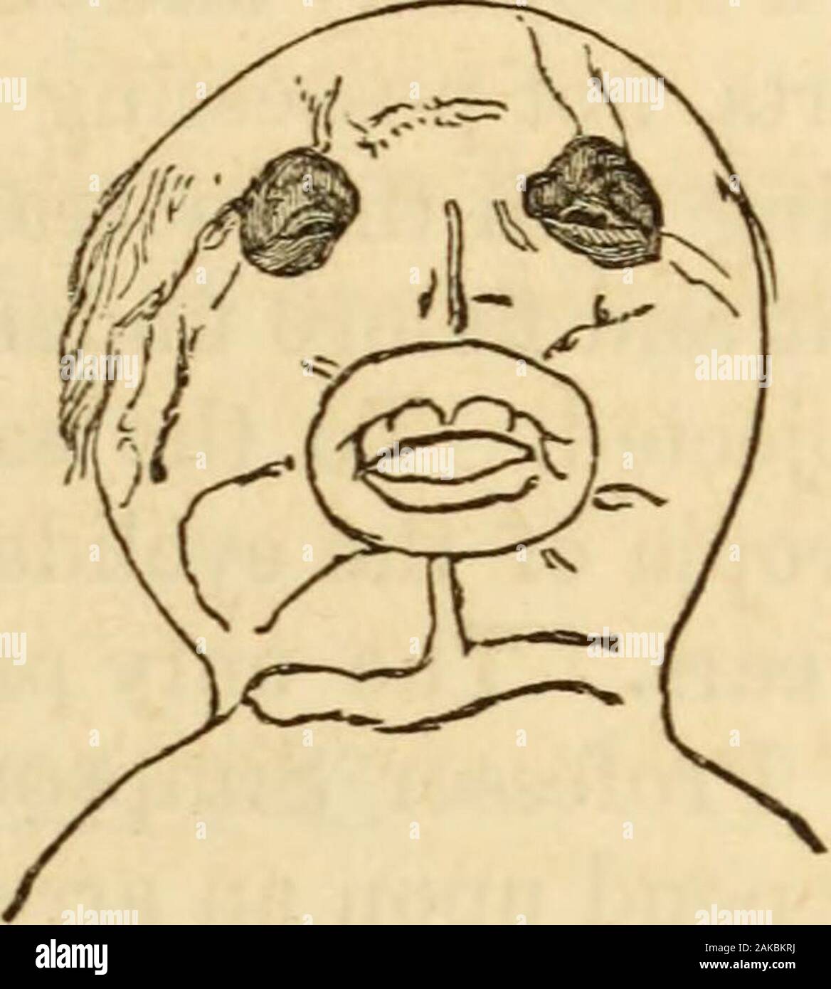The obstetric memoirs and contributions of James YSimpson; . Between the two very distant eyes there was some indication ofa nose, which was very large and flattened (Fig. 42), and indeedonly shown to be such by the two nostrils. The mouth was largely opened, forming an ellipsis with thereturned interior surface of the lips, and surrounding the alveolarparts of the two jaws and the tongue, which was much thickened;in the upper jaw the rudiments of the incisor teeth were very appa-rent ; at each angle of the lips there were three cutaneous fissures ;and in the same manner there was one on each Stock Photo