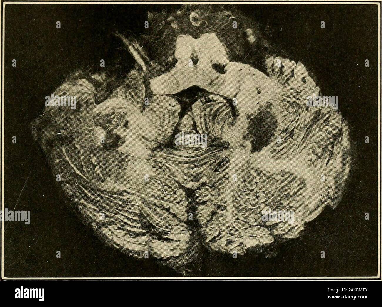 Diseases of the nervous system : a text-book of neurology and psychiatry . function of these olivocerebellar paths is still in question. Asto definite localization for other receptor paths (chemical, etc.) exactknowledge is absolutely wanting at the present time. So far as localization of motor functions in the nuclei is concerned,this seems to have received definite confirmation by the work ofHorsley {loc. cit.). Cerebellar tumors are relatively frequent. Almost one-third ofthe brain tumors occurring in childhood and adolescence are of cere-bellar origin. In order of frequency one finds gliom Stock Photo