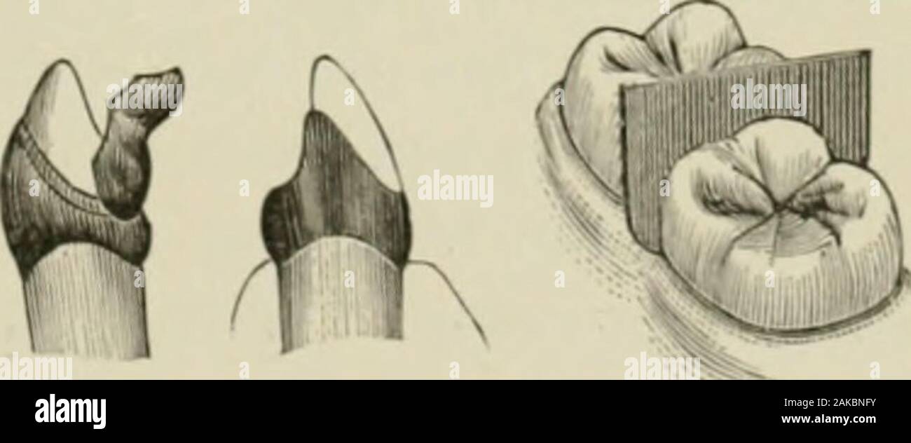 A practical treatise on artificial crown- and bridge-work . After trimming to those lines, and careful replacement andburnishing on the tooth, the collar and half-cap are removed,filled with wet plaster and marble-dust, and the platinum solderedto the gold. It is then placed on the tooth, burnished into all theinequalities of the tooth, very carefully removed, invested, andenough solder flowed over the piQ 475  fio. 476. yio. in.platinum to cover and give itstrength. Fig. 476 shows itcomplete on the cuspid. I have feared that a detailedstatement Avould im])ly a longand tedious process, but I h Stock Photo
