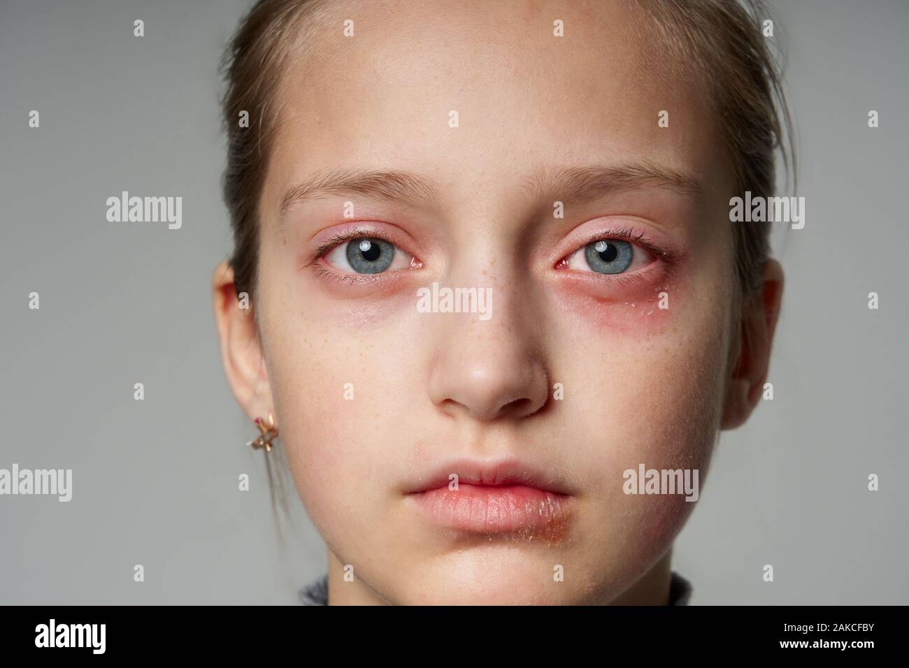 Allergic reaction, skin rash, close view portrait a girl's face. Redness and inflammation of the skin in the eyes and lips. Immune system disease Stock Photo Alamy