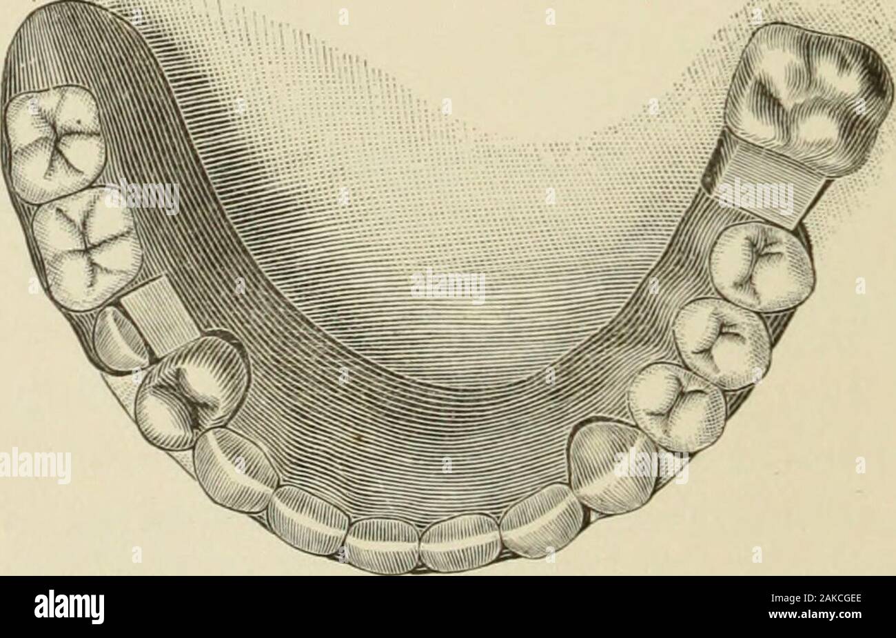 A practical treatise on artificial crown- and bridge-work . Fig. 430.. Fig. 429 shows the cast of a lower jaw in which only the leftsecond molar, left cuspid, and right first bicuspid remained.The molar and bicuspid were fitted with gold cap crowns, and REMOVABLE PLATE BRIDGES. 217 sj^ring socket attachments (Dr. Parrs form) were soldered inproper positions on the crowns, as illustrated. The completeddenture in position supported by the attachments is seen in Fig.430. The under side is shown in Fig. 431. Fig. 431. Stock Photo