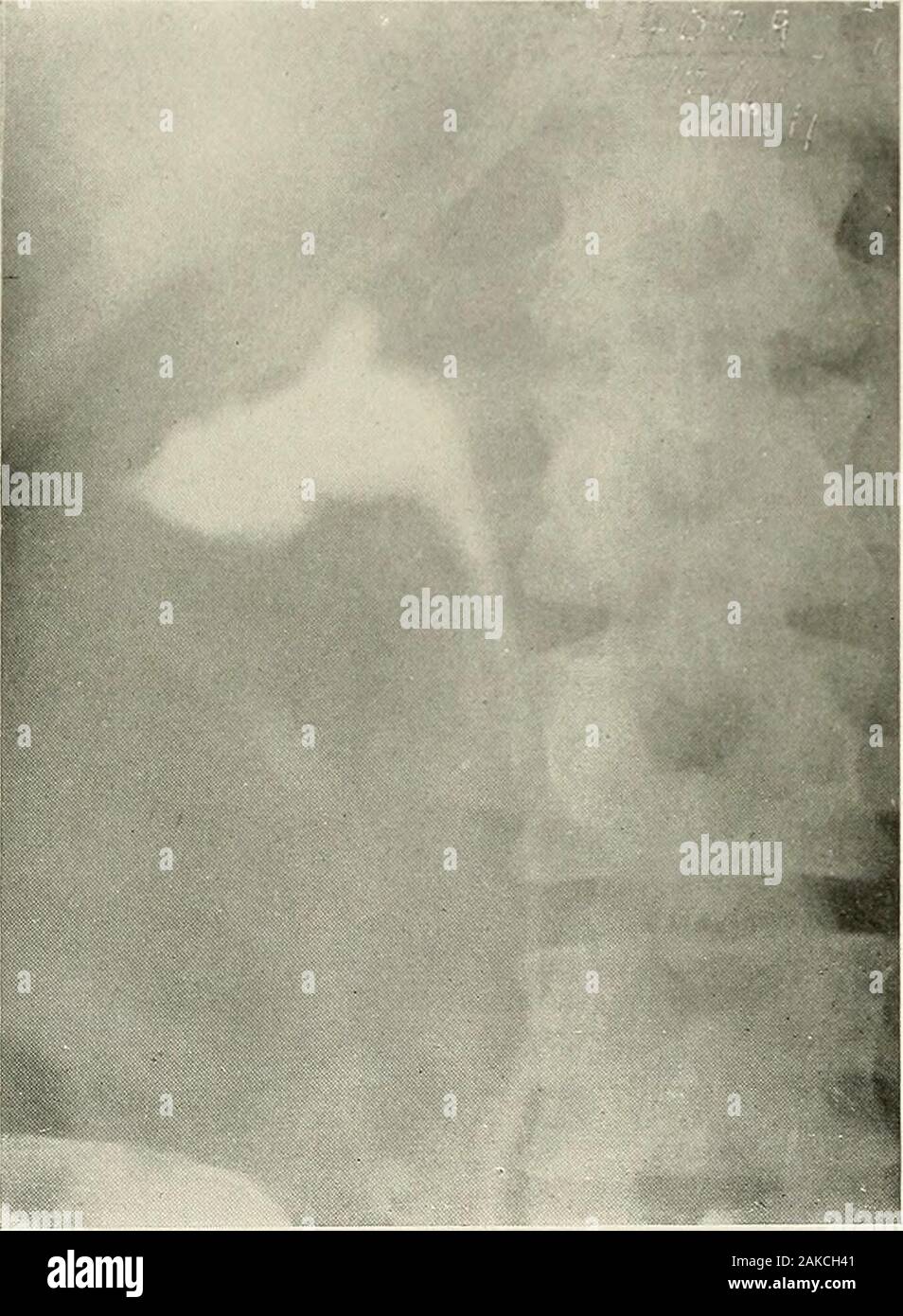 Pyelography (pyelo-ureterography) a study of the normal and pathologic ...