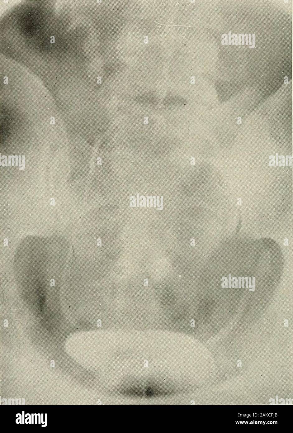 Pyelography (pyelo-ureterography) a study of the normal and pathologic ...
