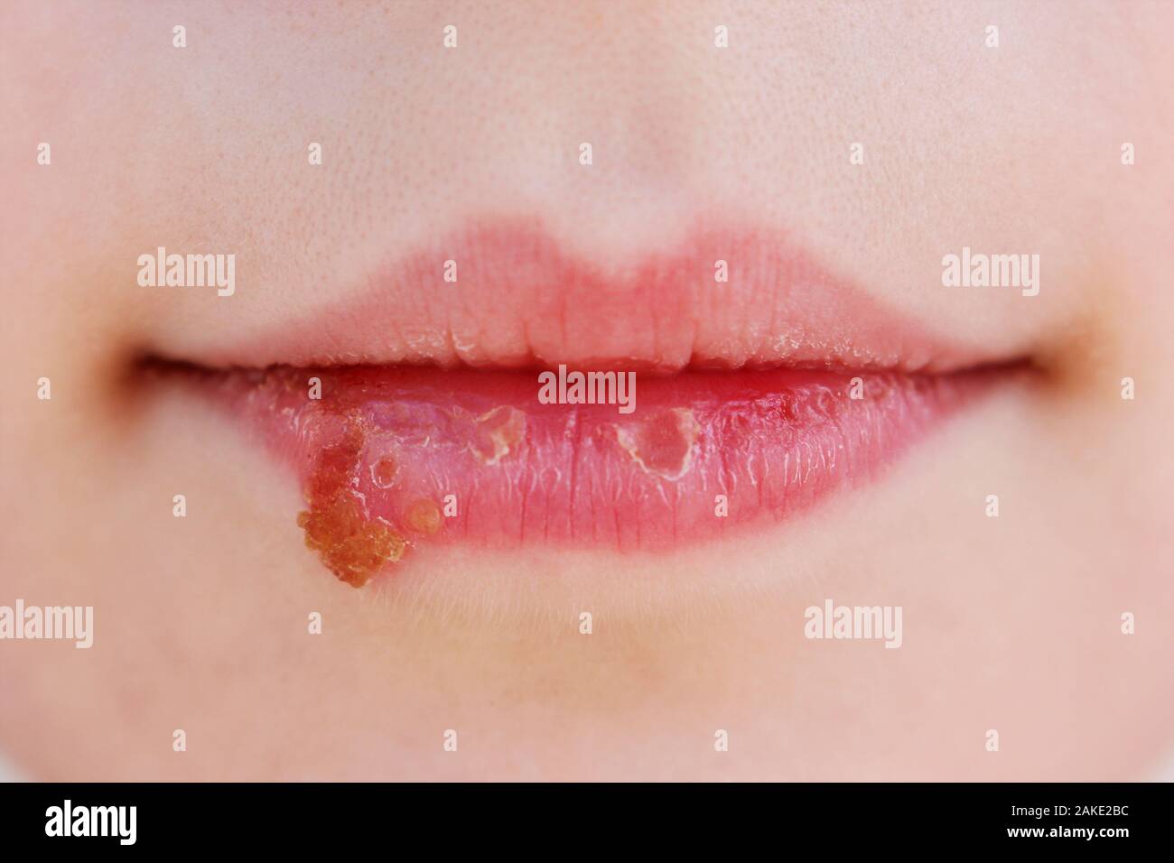 Herpes on lips of child. Treatment ointment. Stock Photo