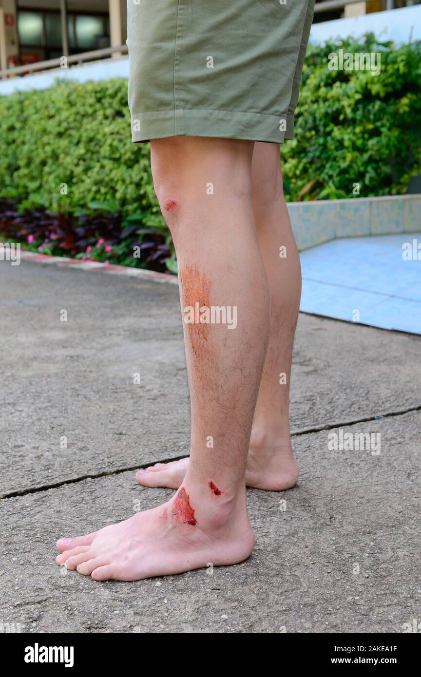 Human legs with fresh wound abrasion from the accident Stock Photo
