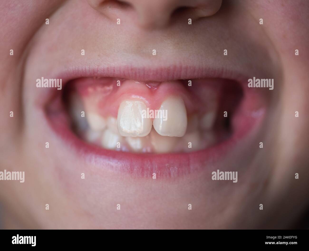 Problems with the teeth of a young boy. Not the correct bite. Stock Photo