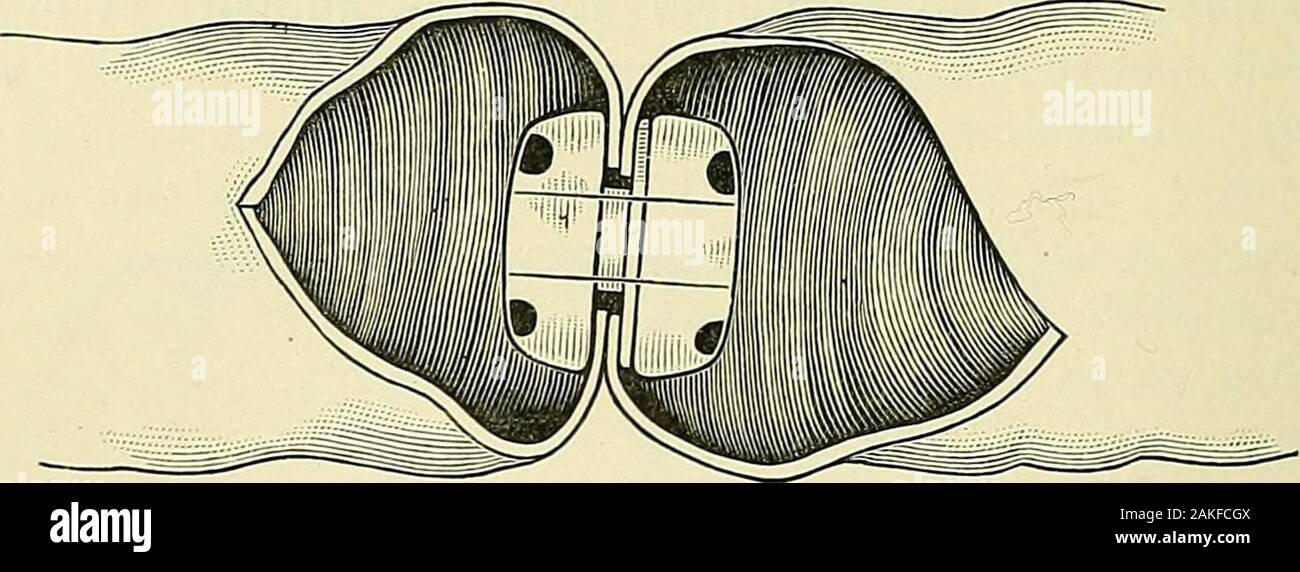 Modern surgery, general and operative. FlG. 933-—Purse-string suture  applied to aperforation (after Schacher).. Fig. 934. -Showing the  application of a double purse-string suture for the arrest of hemorrhagein  large wound (after