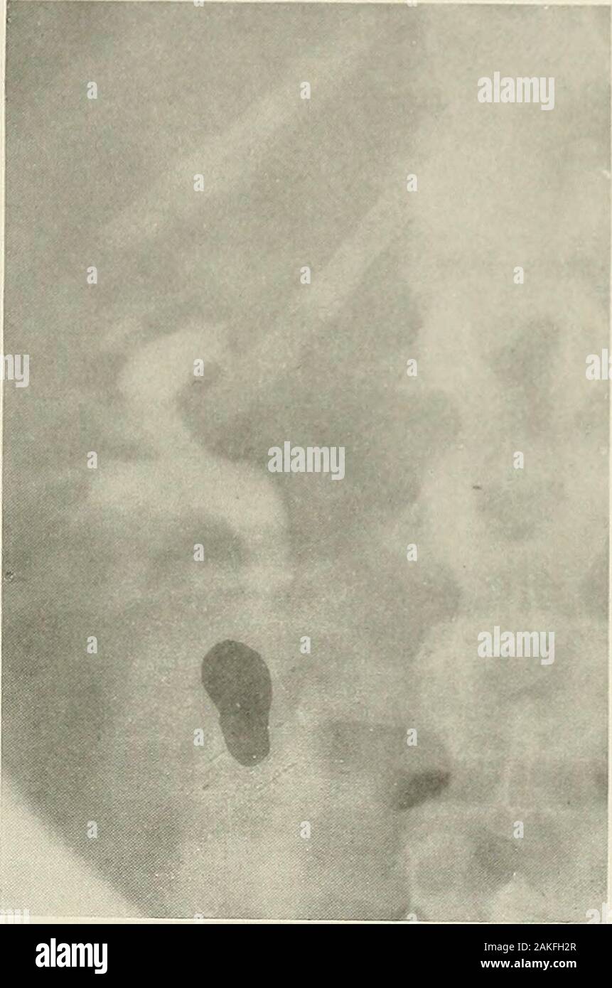 Pathologic Stones Renal pelvic stone hi-res stock photography and images - Alamy