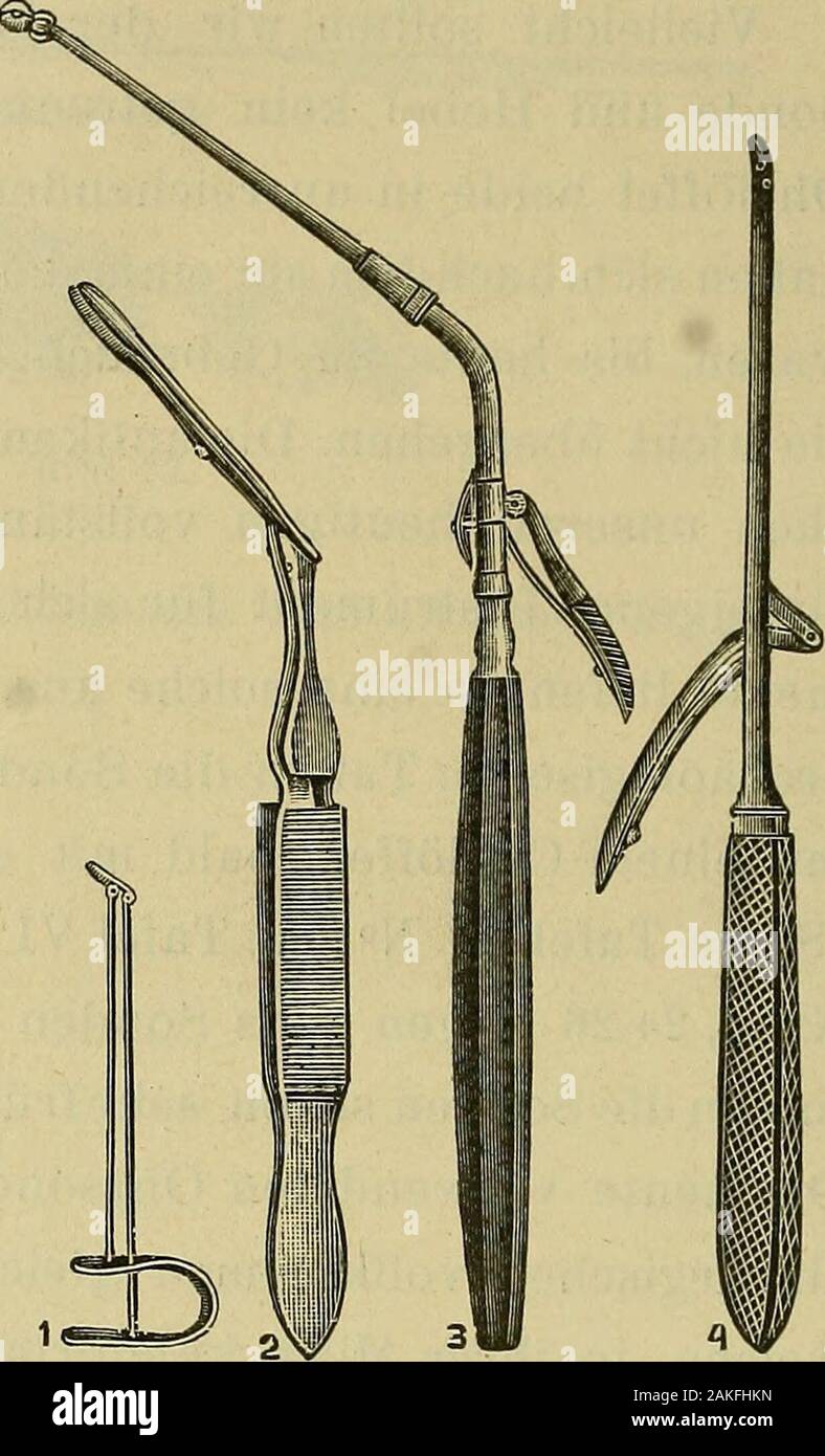 Über fremde Körper, Würmer und Insekten im menschlichen Ohr ihre Behandlung  von den ältesten Zeiten bis Heute... . ritzen von Wasser die Extraction  derfremden Körper gelingt. Der Hebel, als chirurgisches Instrument zur