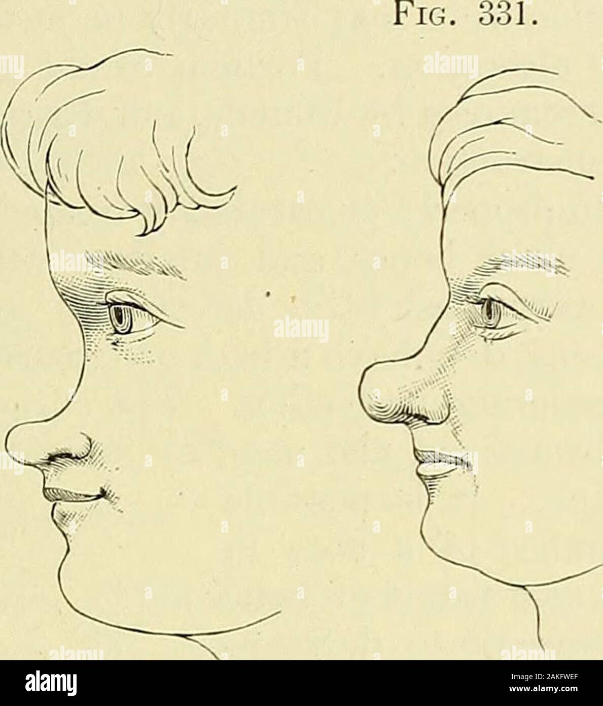 A manual of modern surgery : an exposition of the accepted doctrines and approved operative procedures of the present time, for the use of students and practitioners . Position of adenoid vegetations as commonlylocated in the upper pharynx. (Park.) DEFORMITIES OF THE NOSE. 56T pharynx and are apt to bleed when manipulated. The obstruction tcrrespiration causes the child to breathe through the mouth, and leads tosymptoms pertaining to mouth respiration. These adenoid vegetationsmay atrophy as the child increases in age, but it is often necessary toremove them with forceps or curette because the Stock Photo