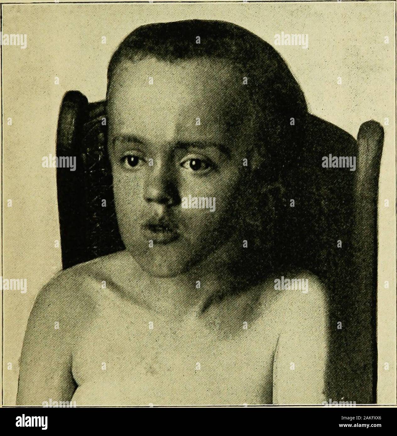 The practice of pediatrics . cing extension of the skull, separation of the bones, and enlarge-ment of the head when it occurs in infancy. Internal hydrocephalusmay be either a general internal hydrocephalus, with distention of allthe ventricles, or a partial hydrocephalus in which the fourth ventricle DISEASES OF THE BRAIN 965 is not involved. Hydrocephalus may be congenital or acquired. Of theacquired form we have to deal with the chronic internal hydrocephalusand an acute internal hydrocephalus—the meningitis serosa of Quincke.Acute Internal Hydrocephalus. Etiology.—While an acute internalh Stock Photo