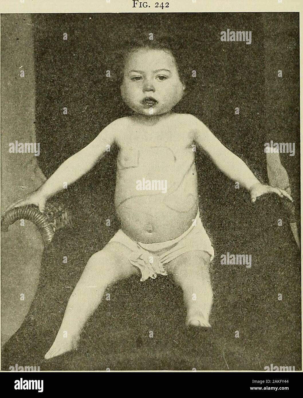 Pediatrics : the hygienic and medical treatment of children . miting, occasion-ally with a chill. Pain on mastication, or sore throat and difficultyin .swallowing, are present in some cases. Very soon the gums be-come spongy and begin to bleed, and with the progress of the diseasea general hemorrhagic tendency develops, manifesting itself underthe clinical picture of a hemorrhagic purpura, with petechiae or ecchy-moses in the skin, and hemorrhages from the mucous membranes. 316 Diseases of the Blood Though the cervical lymphnodes may be slightly enlarged, thereis usually no general l&gt;Tnphno Stock Photo