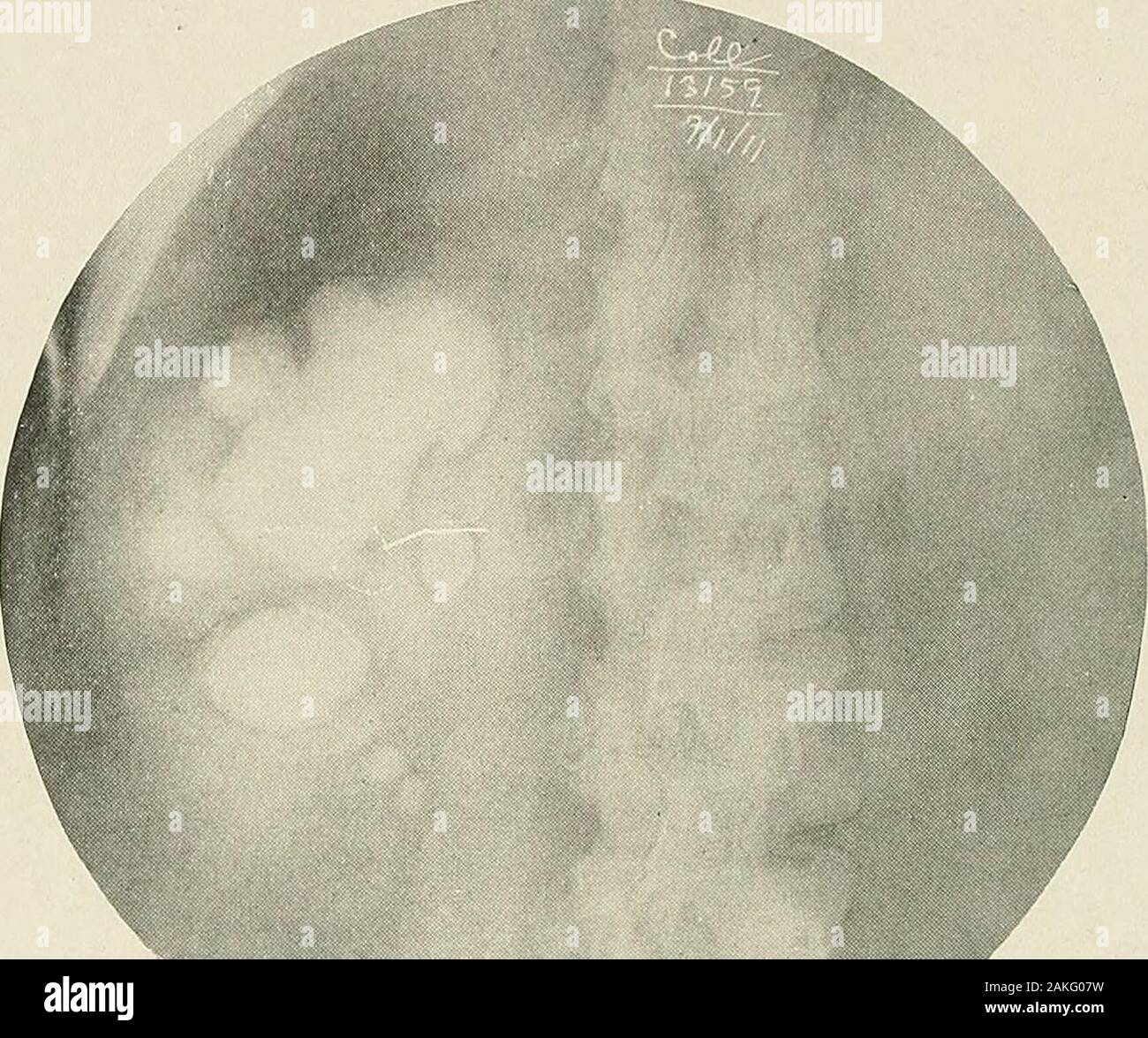 Renal pelvic stone hi-res stock photography and images - Alamy