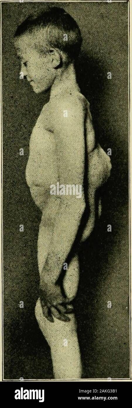 The practice of pediatrics . Cervical Potts disease. Dorsolumbar Potts disease. tion of the membranes of the cord (the pia mater and arachnoid) or alocalized chronic plastic exudate on the inner surface of the dura maybe present. Symptomatology.—In this disease the symptoms referable to the spinedevelop insidiously. They may occur immediately after a traumatism,or a period of weeks or even months elapse. The spine becomes moreor less rigid, there is a certain stiffness to the body movements, and 904 DISEASES OF THE NERVOUS SYSTEM localized pain and tenderness are presented. Subjective symptoms Stock Photo