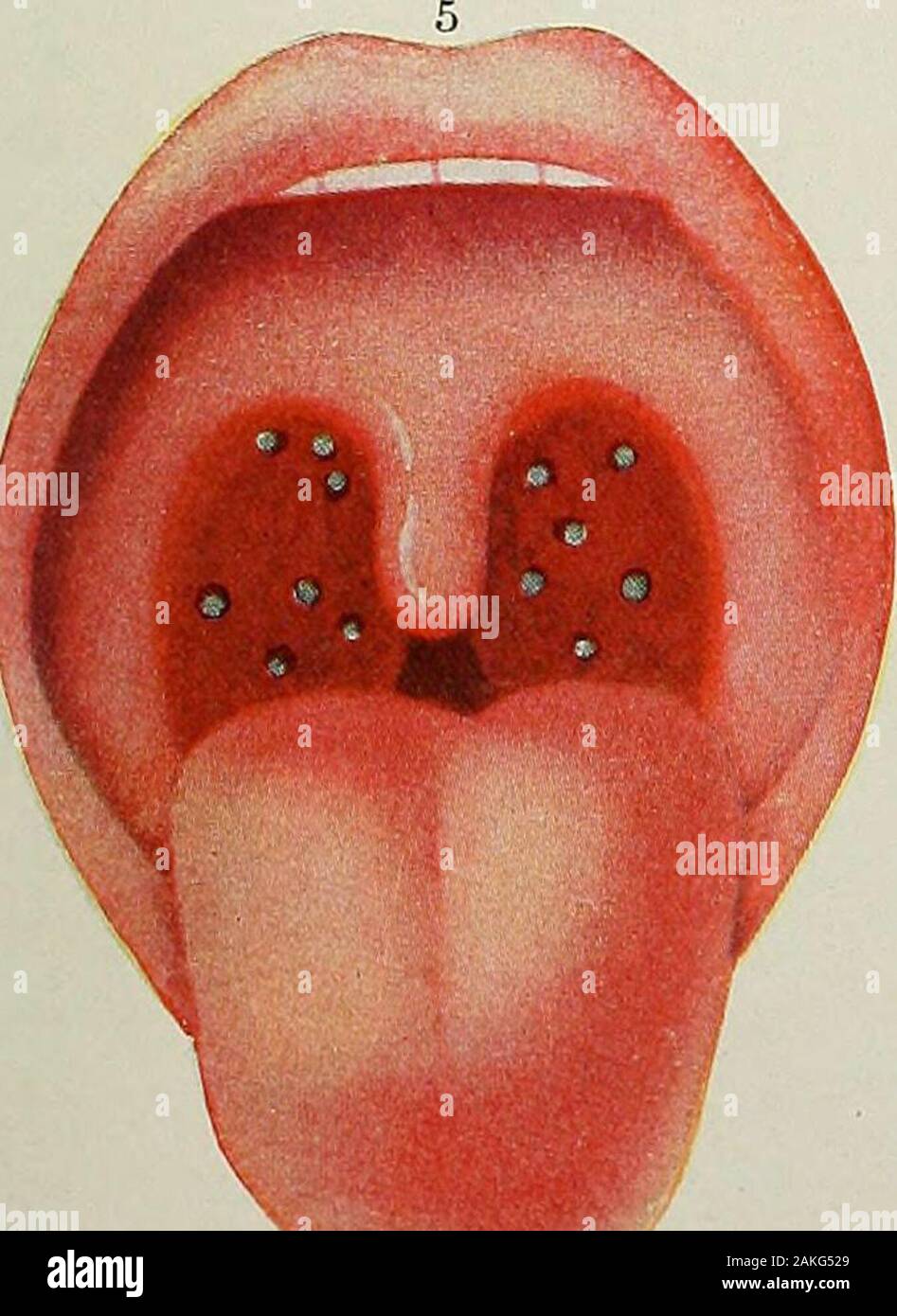 Ulcerosa High Resolution Stock Photography And Images Alamy