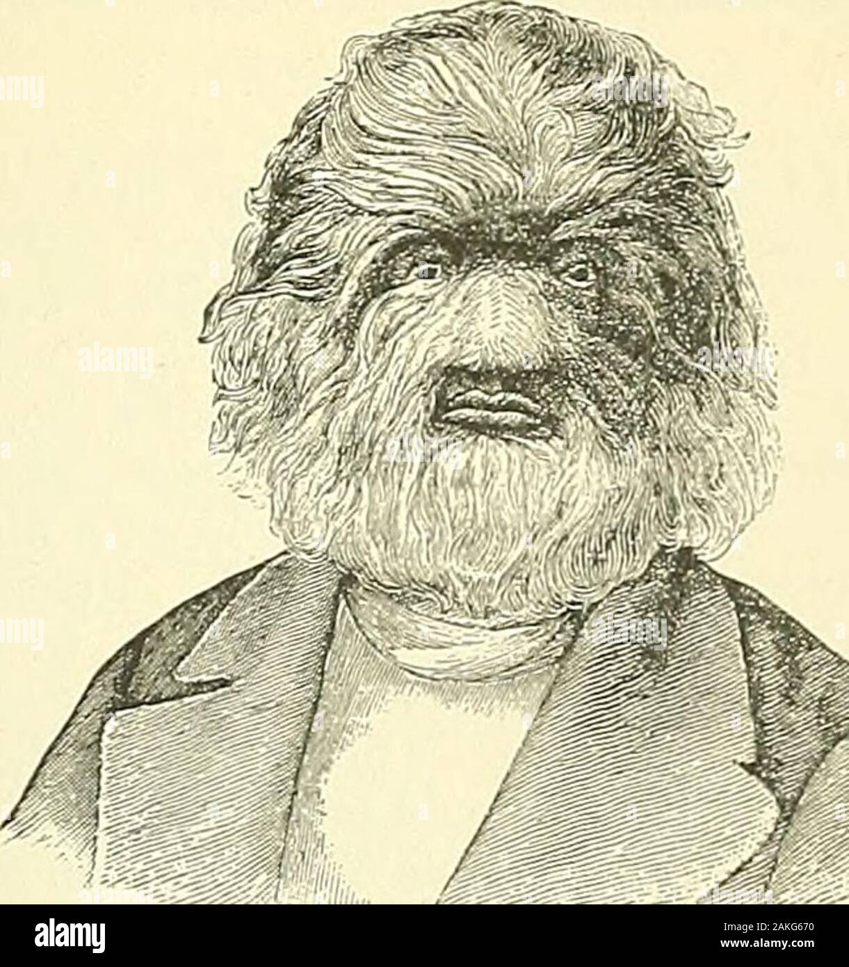 Excessive hair growth hi-res stock photography and images - Alamy Excessive hair growth hi-res stock photography and images - Alamy