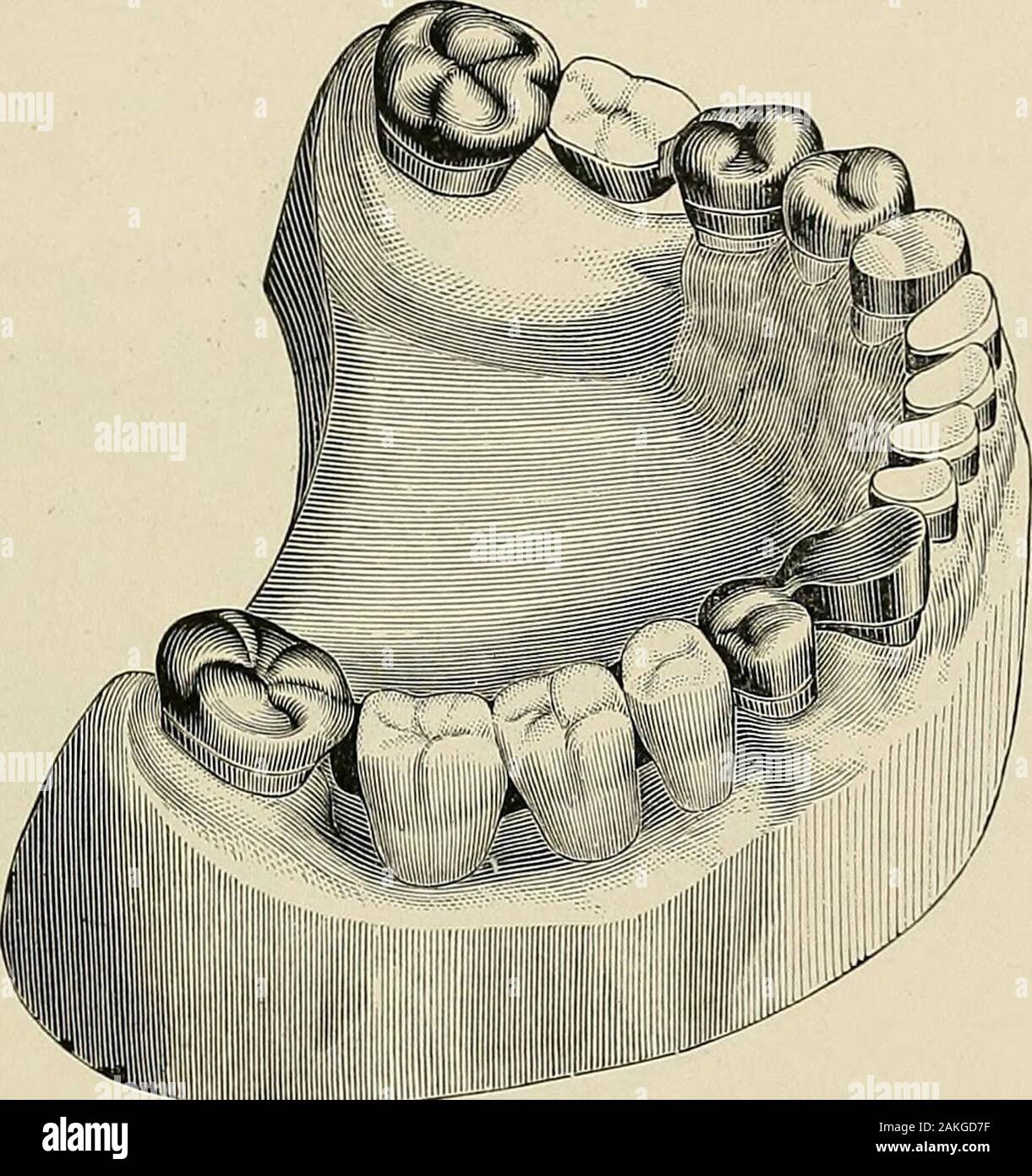 A practical treatise on mechanical dentistry . , which also shows the capped teeth and stumps..This figure likewise shows the results of the novel method em-ployed in crowning the incisors. Gold collars were fitted tight onthe necks of the incisor stumps, and the new style porcelain capsadjusted in the collars, and set in the oxyphosphate cement whichhad been packed into the collars; thus at the same time fasteningthe collars on the stumps and the caps in the collars. BRIDGE DENTURES. 623 Fig. 628 illustrates the finished crowns and bridges, which latterwere secured in position by placing a sm Stock Photo