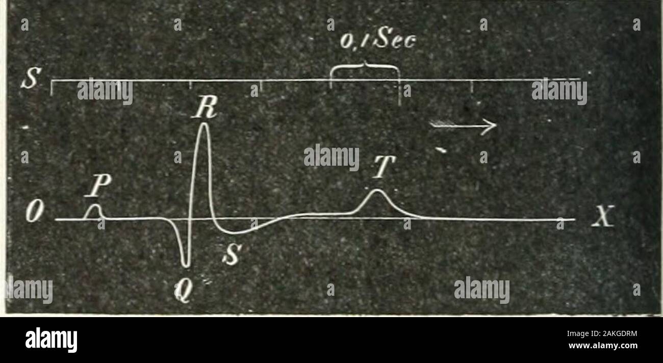 A reference handbook of the medical sciences, embracing the entire range of scientific and practical medicine and allied science . Fig. 729,—Simultaneou.* Photograra of a Single Beat (BlackLine) and of the Accompanj-ing Electrical Change, indicated bythe level of the black area, which showB the varying level of mercuryin a capillary electrometer. I. First phase, base negative to apex;II, second phase, apes negative to base. (Waller.) finally, that the contraction ends by disappearingfirst at the apex. It evidently follows the recurrentpath of the superficial oblique fibers beginning andending Stock Photo