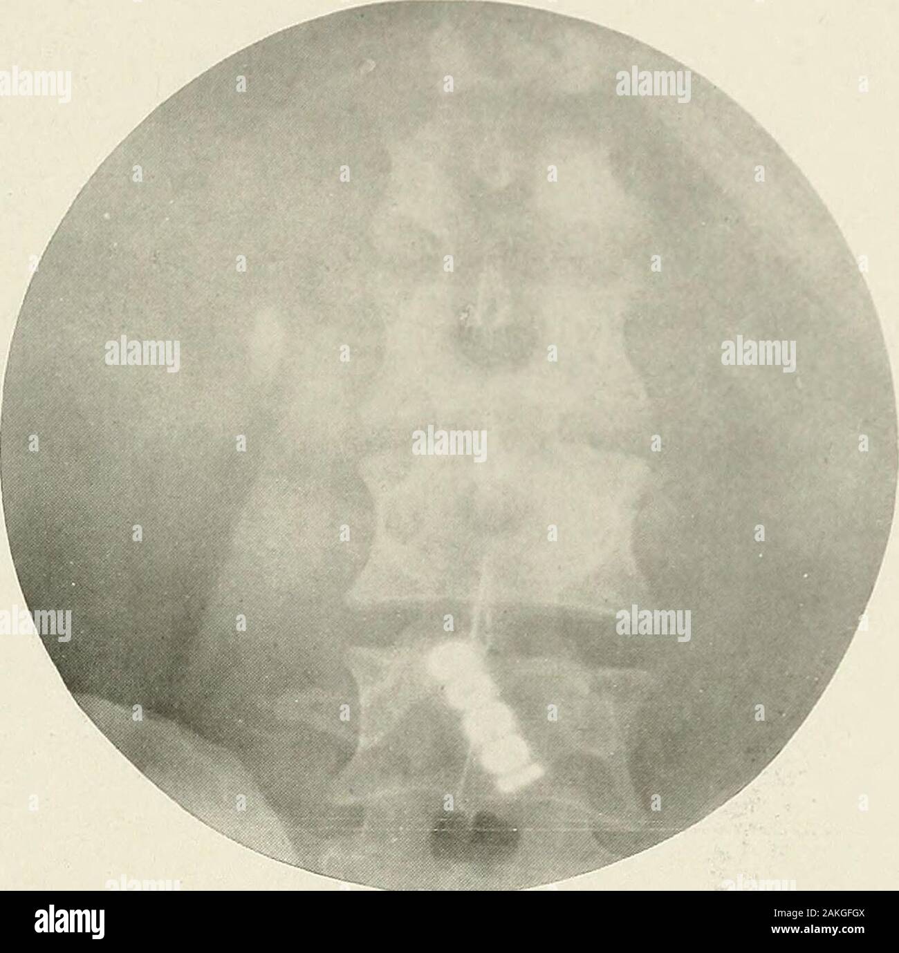 Pyelography (pyelo-ureterography) a study of the normal and pathologic anatomy of the renal pelvis and ureter . Fig. 157.—Renal stone (pyelogram of Fig. 156). RENAL STONE 189 157 the individual calyces are dilated so as to form an irregu-lar triangular outline while the true pelvis is unusually small.The stones situated in the calyces and pelvis caused pyelitis,which in turn caused the inflammatory dilatation. In Fig. 158 a stone shadow is seen in the right kidney area. InFig. 159 the outUne of the stone is obhterated by that ofthe true pelvis, which is well dilated, while the outlines of. Fig Stock Photo