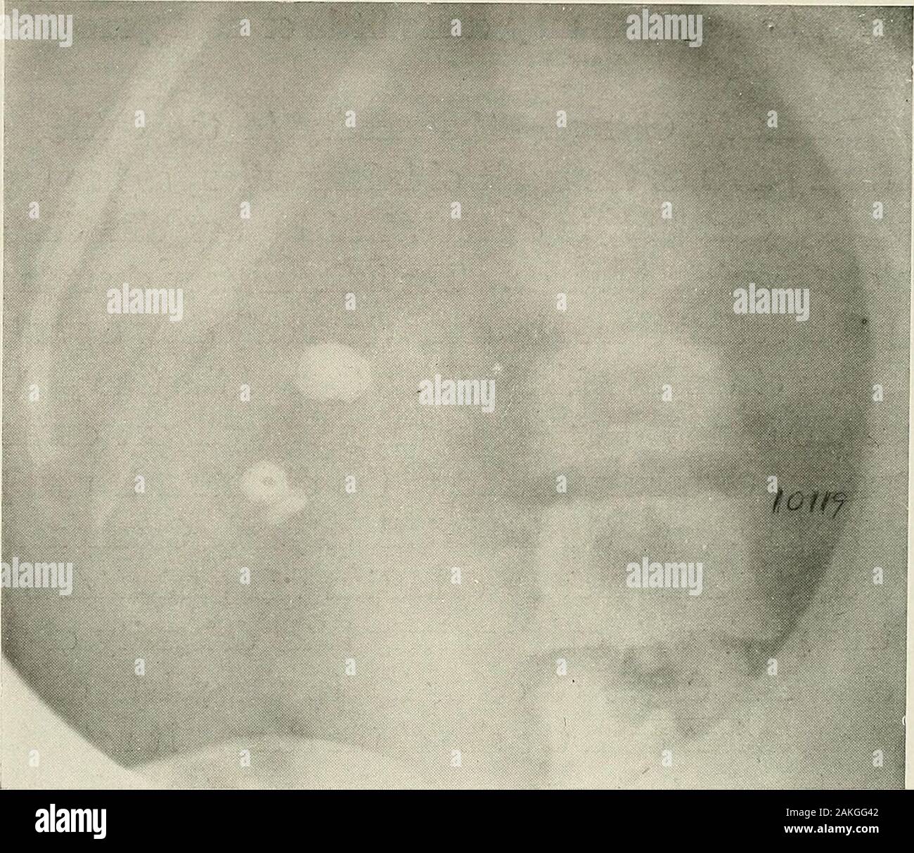 Pyelography (pyelo-ureterography) a study of the normal and pathologic ...