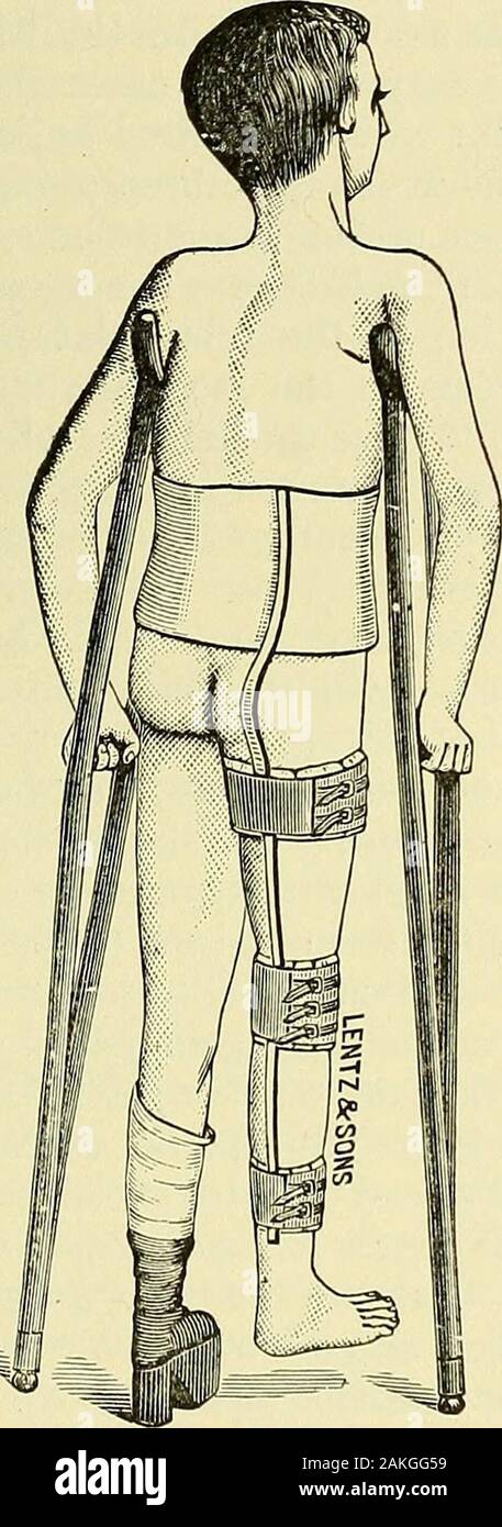 A manual of modern surgery : an exposition of the accepted doctrines and approved operative procedures of the present time, for the use of students and practitioners . Mortons extension apparatus for traction in tubercular coxitis. ogenic infection. Sometimes the wound made for evacuation of thetubercular pus may be closed antiseptically and union by first intentionobtained. TUBERCULOSIS OF THE HIP JOINT. 509 In cases the symptoms of which have never been very severe effi-cient treatment may sometimes be obtained by a splint from the begin-ning of the disease. This should allow the patient to Stock Photo