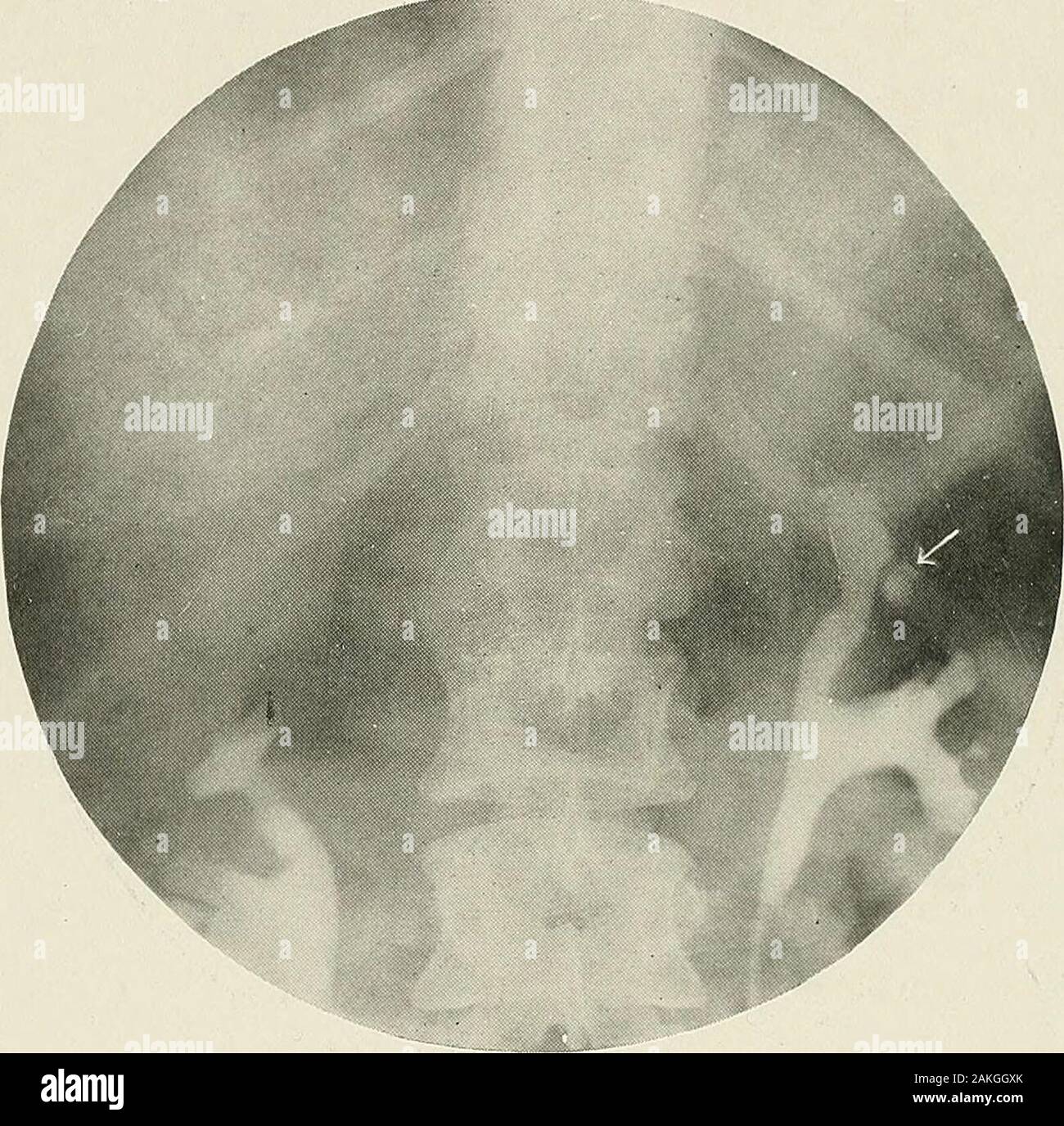Renal pelvic stone hi-res stock photography and images - Alamy