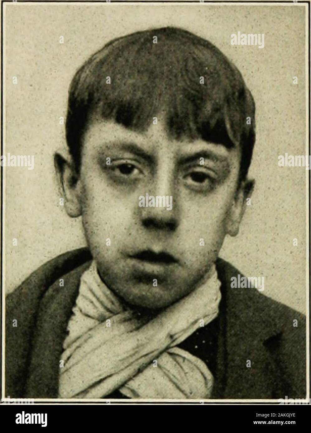 The practice of pediatrics . ng the gross symptomsdescribed above. The  typicaladenoid facies is not seen inyoung infants, but the signs areusually  sufficiently definite toform the basis for a diagnosis.Snuffling is very, image size:998x1390