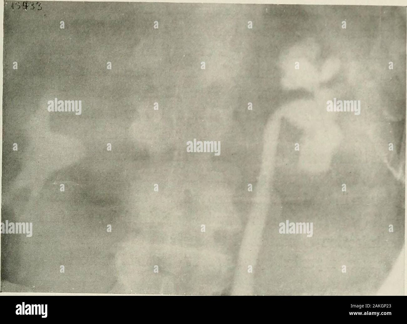 Pyelography (pyelo-ureterography) a study of the normal and pathologic ...