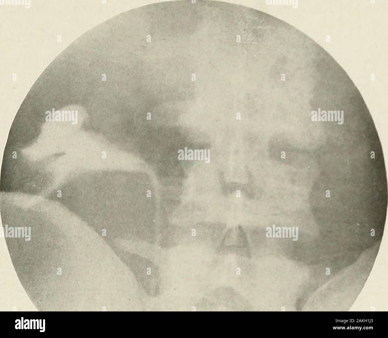 Pyelography (pyelo-ureterography) a study of the normal and pathologic ...
