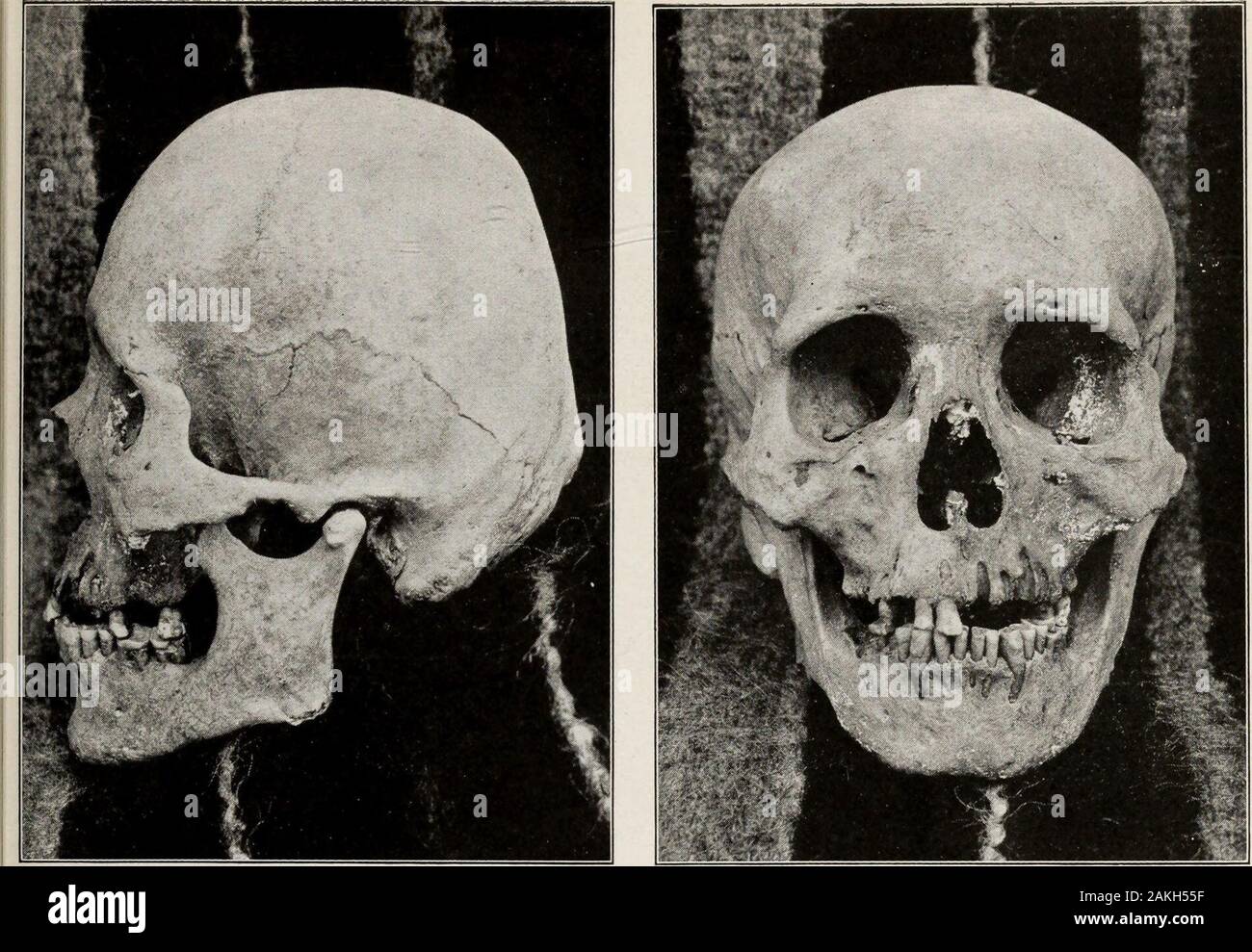 Compared Skulls High Resolution Stock Photography And Images Alamy