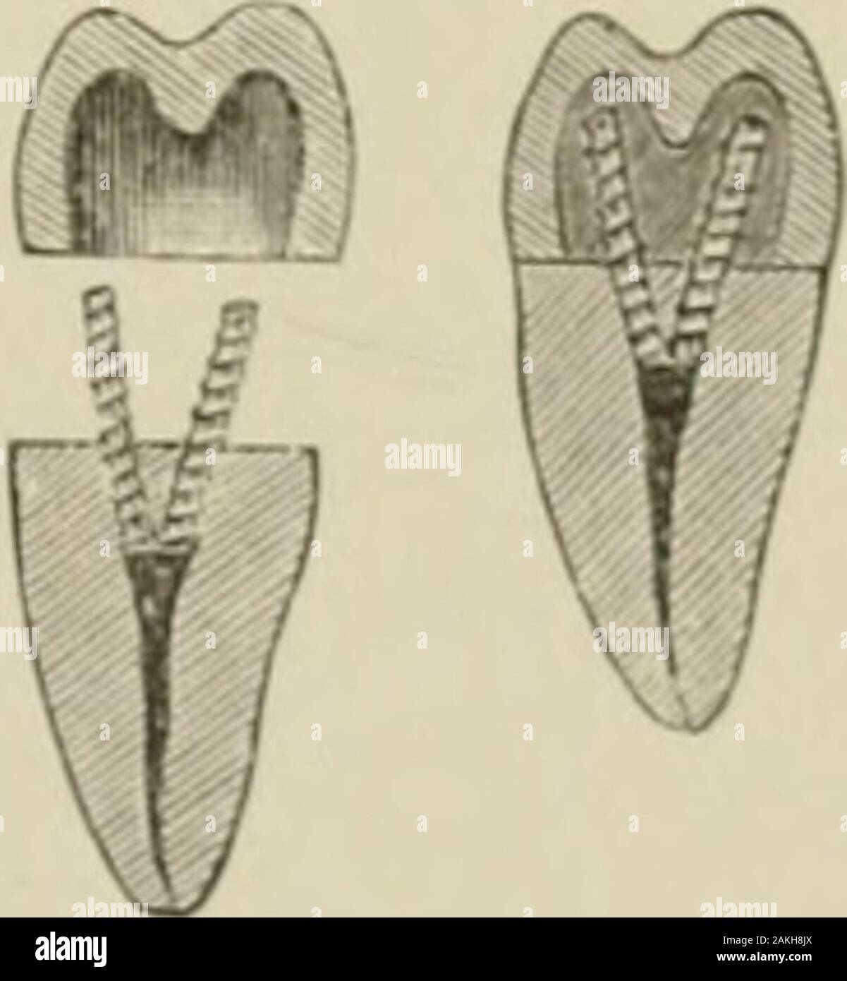 A practical treatise on artificial crown- and bridge-work . ge the root-eanal so thata threaded pin of proper size will pass in easily, par-^ tially fill the canal with zinc phosphate, and press theA pin to its place with pliers. The crown should then beU filled with zinc phosphate and pressed to its place, carebeing taken to hold it in jiosition until the cementsets (Fig. 83). If any operator distrusts the ability ofzinc phosphate to make a perfect joint, a small &lt;[uan-tity of silver amalgam or gutta-perc-ha can beised to ^^- ^- ^^- ? ^^°- ^-advantage. This crown is strong, andduring its Stock Photo