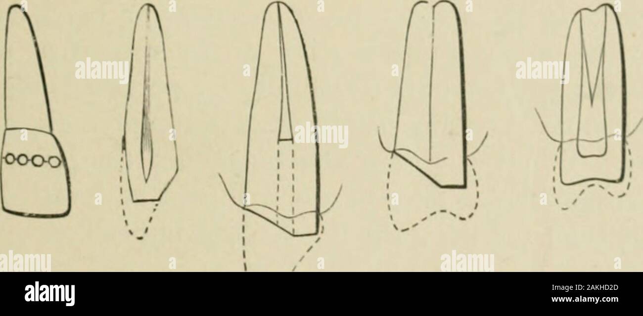 A Practical Treatise On Artificial Crown And Bridge Work Shaft Is Inserted In The Opening In The End Of The Root Shaplxg Teeth A Sd Roots For Crowx Horh 41 And The Scraper