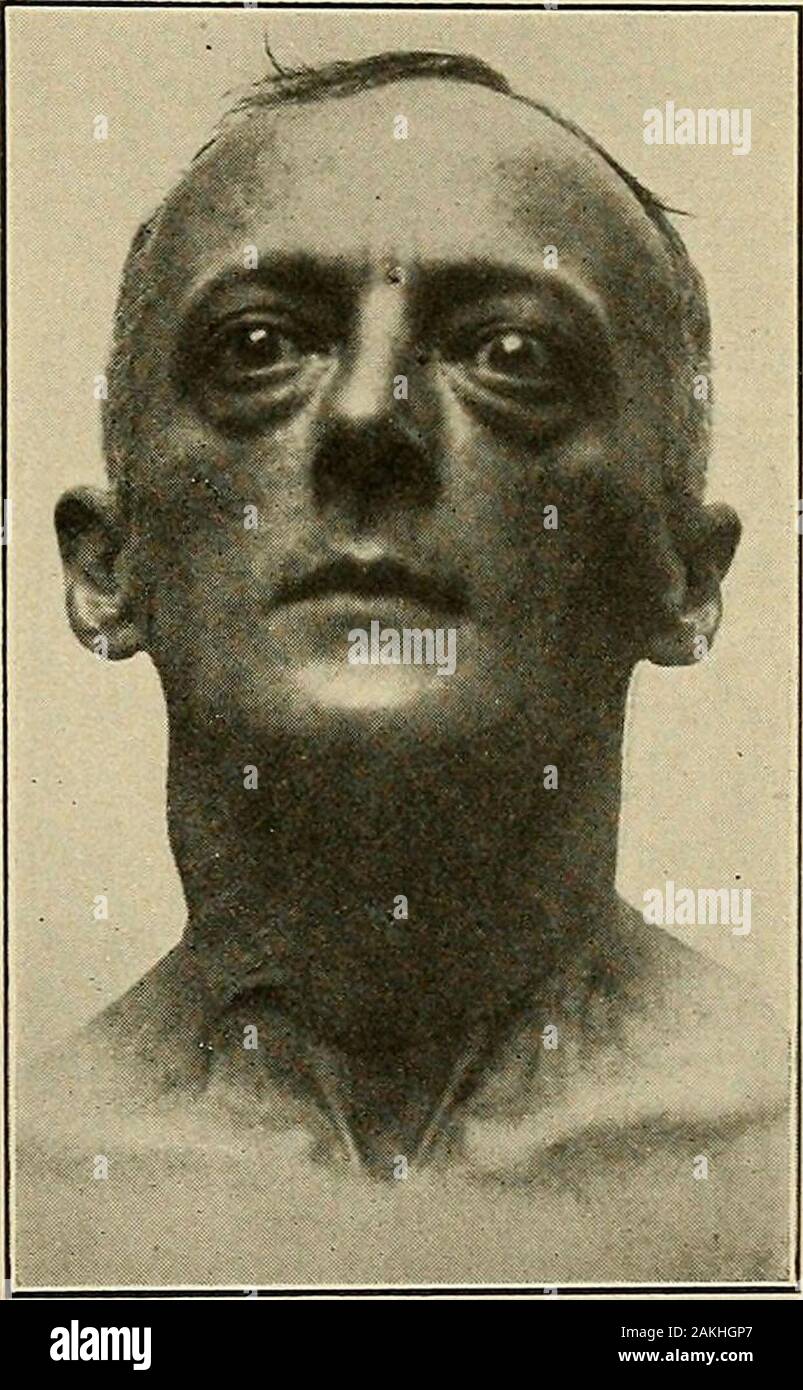 Exophthalmic goitre hi-res stock photography and images - Alamy