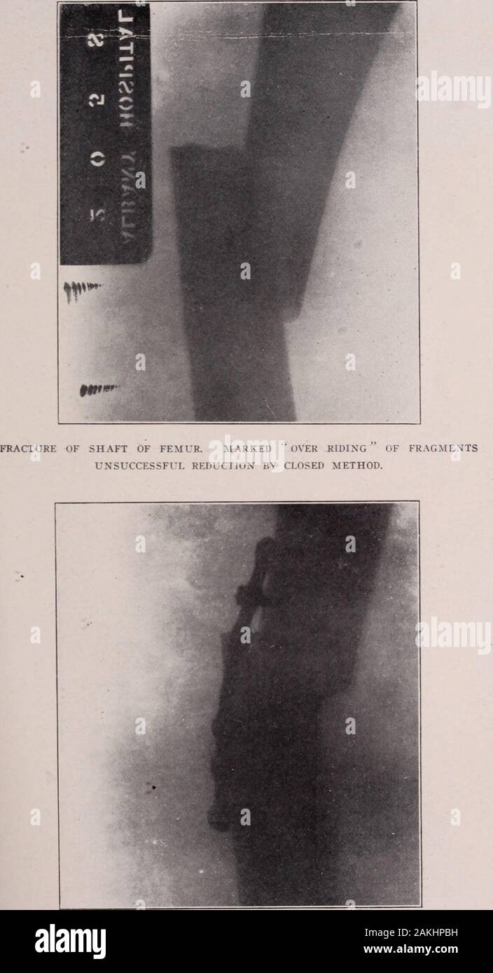 Albany medical annals . the Bone Plate. Certain types of fractures, at the present time, call for the useof the open method of treatment. Since the introduction andpopularization of Lanes method we are hardly justified inaccepting results that formerly were considered satisfactory.Fractures of the shaft of the femur with a small degree ofshortening and fair functional result, can no longer be consideredsatisfactory from the standpoint of a surgeon who would con-sider himself as abreast of the times as an operator in this orfor that matter in any other field of surgical endeavor. Thatwhich hold Stock Photo