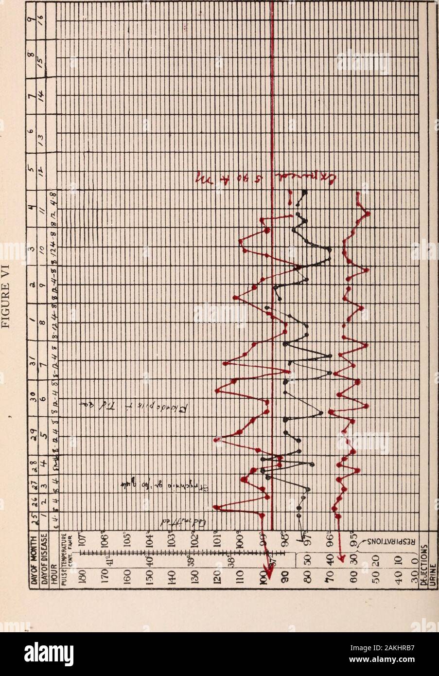 Albany medical annals . Patient in right lateral position. A. Percussion note is hyperresonant from 2nd rib to area of liverdulness. except over fluid (B).Left side of chest posteriorly not examined.Examination of March 30th, 1912. at this time (see Fig. IV) gives a combined picture of pulmonary tuber-culosis and shock; a somewhat lower temperature with very markedvariations and a very noticeable increased rate of pulse and respiration. The points of particular interest in this case were:1. He had no recollection of any acute onset of the trouble.The leakage of air into his pleural cavity had Stock Photo