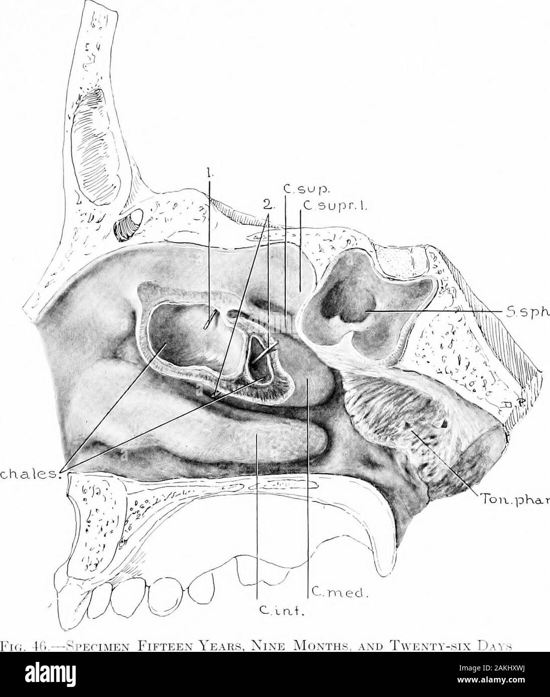 Development and anatomy of the nasal accessory sinuses in man; observations based on two hundred and ninety lateral nasal walls, showing the various stages and types of development of the accessory sinus areas from the sixtieth day of fetal life to advanced maturity . DaysOld. (Series D, No. 76.)I^ateral portions of the frontal, ethmoidal, maxillary, and sphenoidal areashave been removed bjf sagittal incisions. Note the marked extent of the sinussphenoidalis into the pterygoid process. The ridge which is seen on the floorof the sinus sphenoidalis overUes the nervus canalis pterygoidei (Vidii). Stock Photo