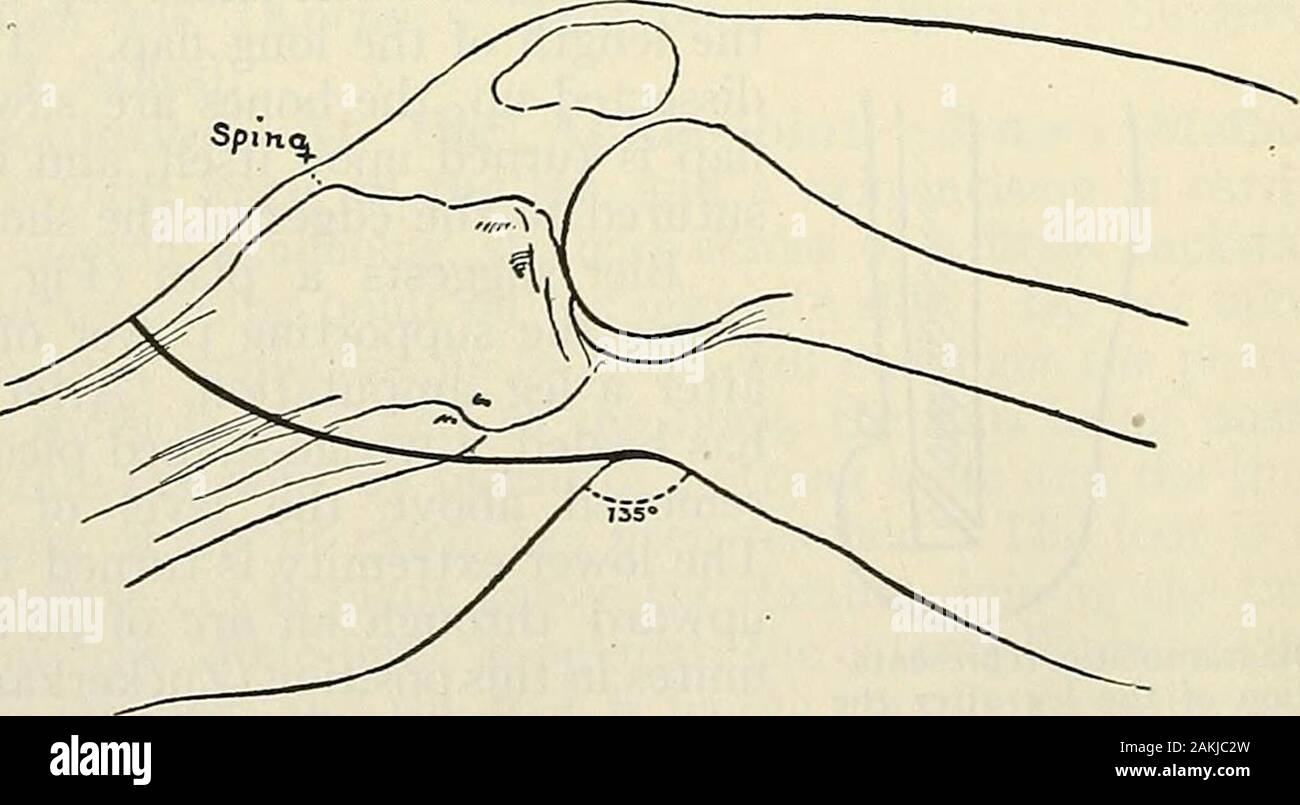 Modern surgery, general and operative . Fig. 984.—Amputation of the legby a long posterior flap (Gross).. Fig. 985.—Kochers oblique incision for disarticulation at the knee-joint (Kocher). Amputation Just Below the Knee.—The seat of election is i inch belowthe tuberosities. No muscle is needed in the flap. Cut two flaps of skin,equal in size and of semilunar shape, these flaps beginning anteriorly 2 inchesbelow the tuberosity of the tibia. One flap is antero-external and the other ispostero-internal. The flaps are pulled up, the anterior muscles are cut as highup as possible, and the posterior Stock Photo