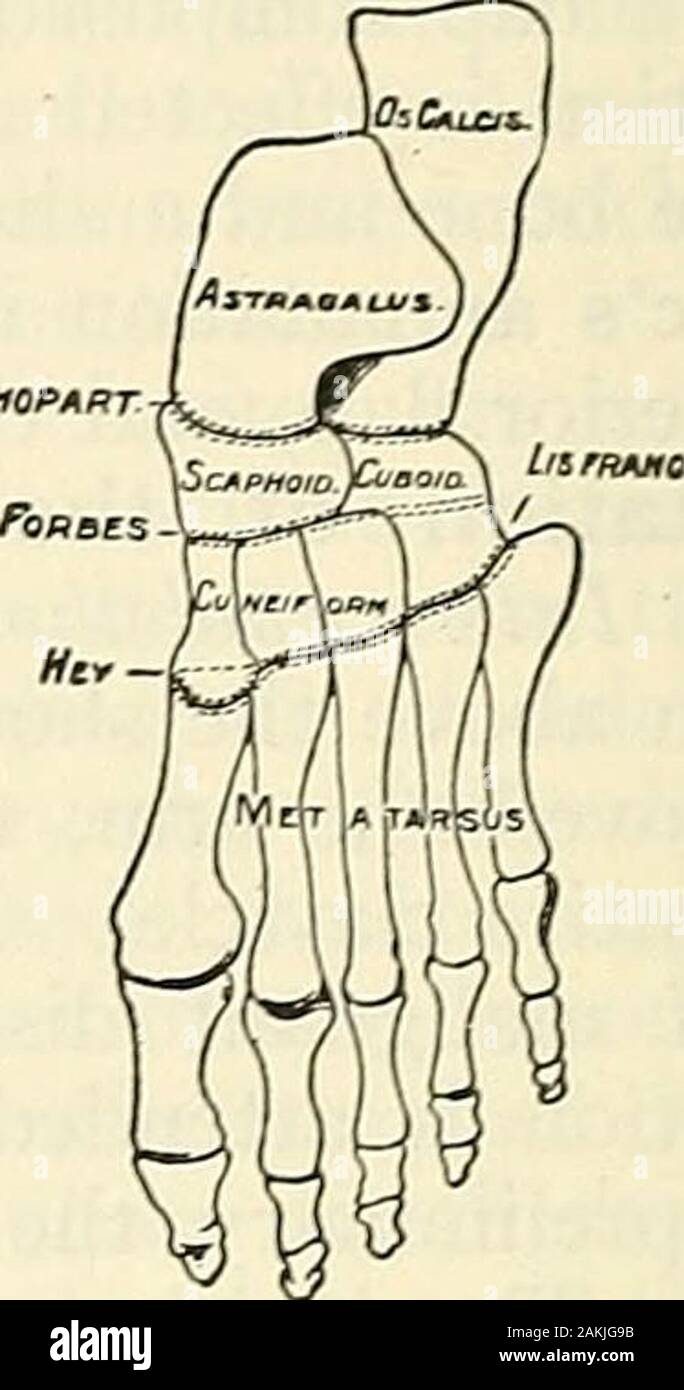 Modern surgery, general and operative . Fig. g7i.—Amputation of the toes with andwithout the metatarsal bones. Fig. 972.—Lines in amputations of the foot(Gross). the metatarsal bone of the great toe. A very short semilunar dorsal skin-flapis thus formed. Figure 977 shows the flaps as cut by Kocher. After the skin-flap has been dissected back for  inch the tendons are divided, and the flap,which now contains aU the soft parts, is dissected back to above the joint. Along plantar flap is cut, reaching from the origin of the first flap to the necksof the metatarsal bones. The skin-flap is dissect Stock Photo