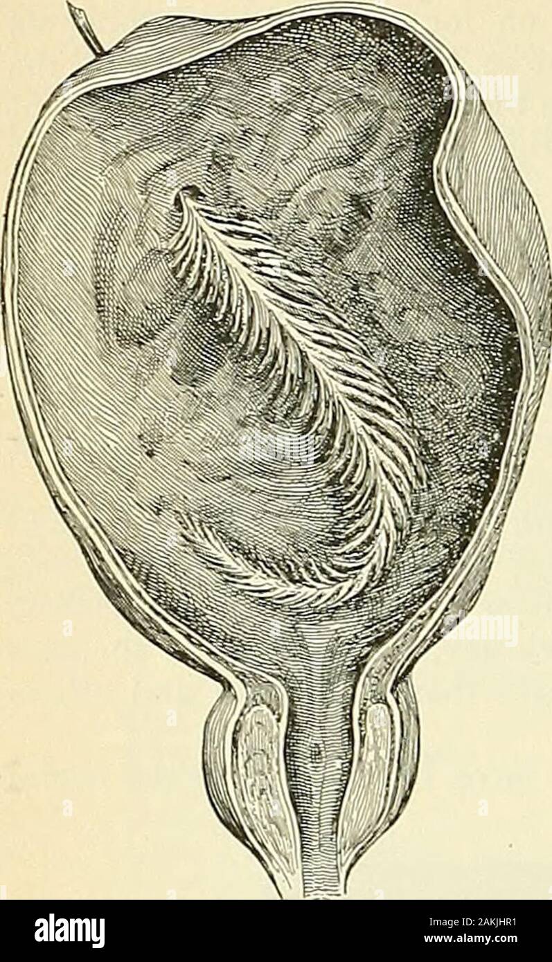 An American Text Book Of Genito Urinary Diseases Syphilis And Diseases Of The Skin N The First And Second In Con Sistency The Former In Color Vary From Gray To White The Latter