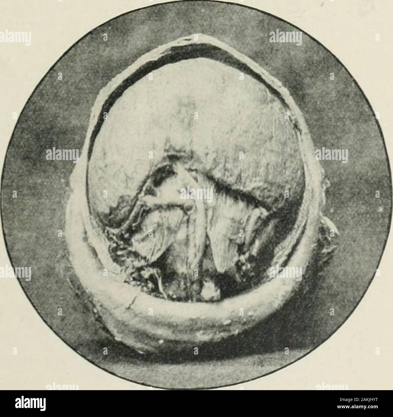 Transactions . Human cyclops with microphthalmos.Fig. 10.. Brain from Fig.  9, showing large cerebral cyst as the result ofdistension of the anterior  end of the neural tube. 120 DETACHMENT OF THE RETINA.