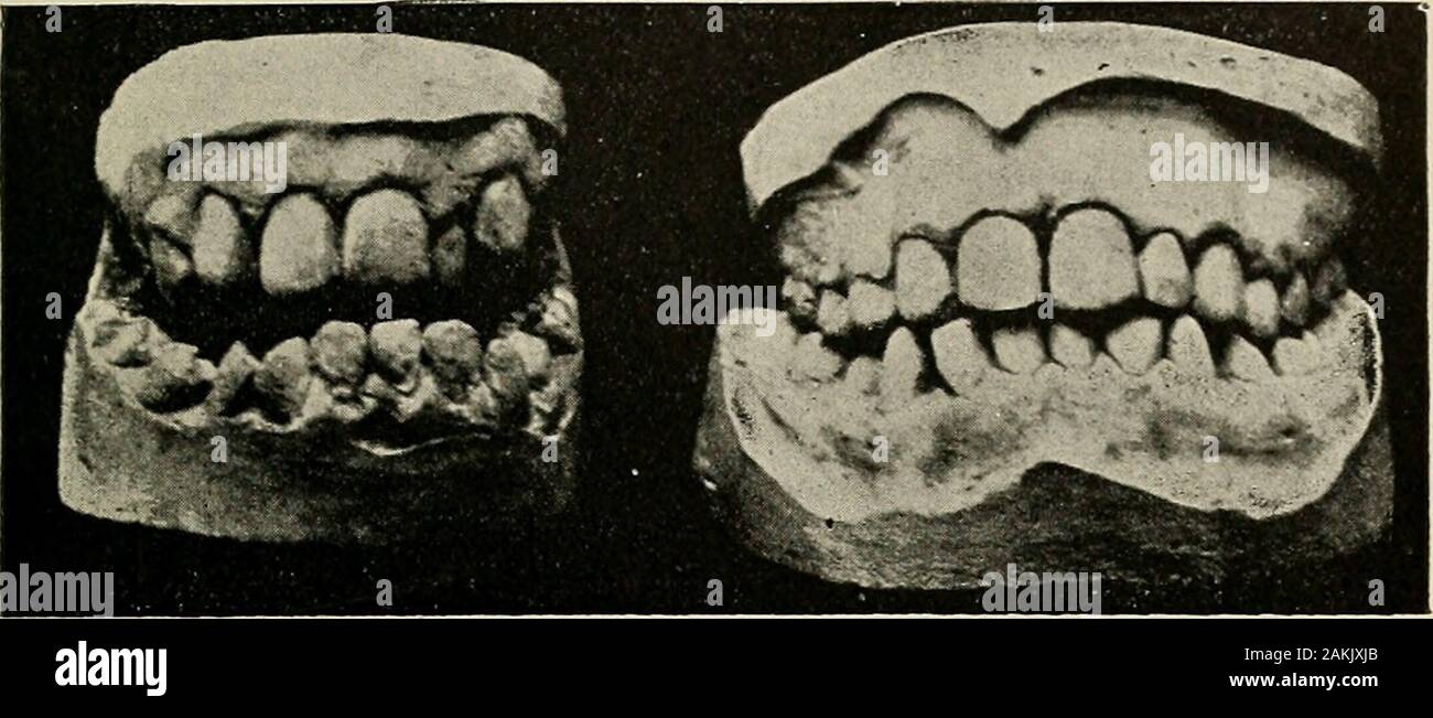 A practical treatise on mechanical dentistry . April, 1893.Case i.—Half-tone copies of photographs of plaster casts, made before and after(466; completion. Fig. 266. Fig. 267.. November, 1892. April, 1893. Model from occlusion impression. Fig. 268. Fig. 269. Stock Photo